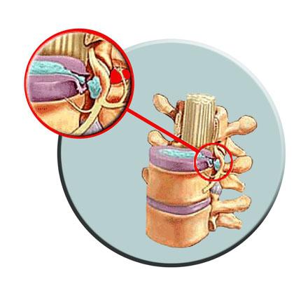 θεραπεία της σπονδυλικής κήλης
